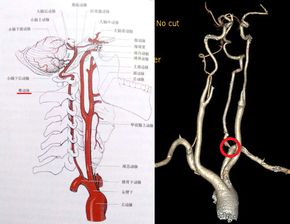 头晕也要警惕椎动脉起始部狭窄