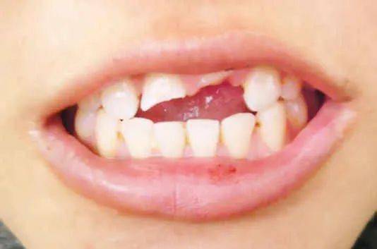 成人掉牙齿是什么征兆,谁是你牙齿松动、脱落的元凶？