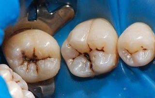 有虫牙的人不能洗牙 洗牙前必知的几件事