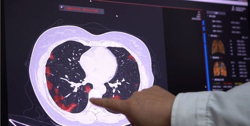 联影医疗智能CT进入上海社区医院,自动识别新冠肺炎危重患者