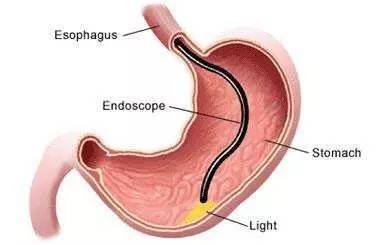 你知道吗 胃镜还能从鼻子做 这样舒服多了 