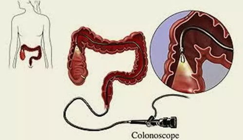 健康丨一般什么情况下需要做肠镜 或者是有什么症状 