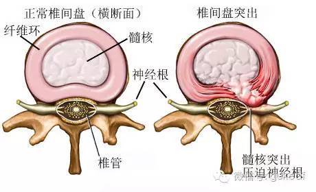 爸爸最近检查出来说腰椎间盘突出，公司同事给我推荐千年活骨膏说是纯中药的有效果爱美？有人听说吗