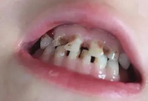 孩子准备换牙了,乳牙龋齿需要补牙吗