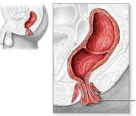 肛门为何长包
