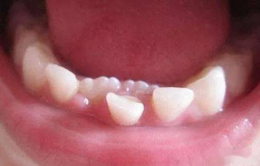 发现即矫正 12岁前必须处理的20种儿童牙颌畸形