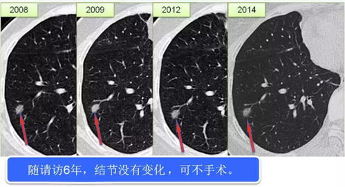 肺癌一经发现就是晚期 都怪这2个病变信号,发现的太晚了