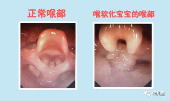 宝宝喉咙有痰么 老是 咕咕 响 