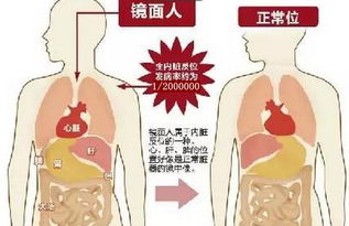 全国罕见 福建一名1岁女童竟是 镜面人 ,五脏六腑全长反 