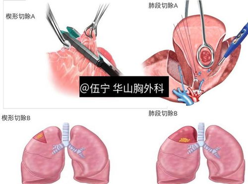 楔形切除,肺段切除和肺叶切除三种手术方式的优缺点和应用