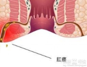 肛瘘需要吃那些药物