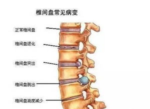 女人喊腰痛原来是这么回事,早治疗早好 