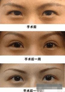 韩式定点双眼皮的是怎样形成的 手术过程 