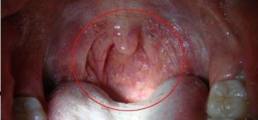 喉咙有绿泡是什么东西