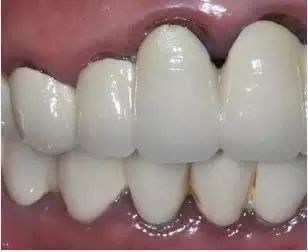 为什么牙医建议你选择全瓷牙冠,看完你就明白了