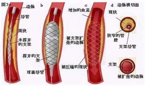 心脏支架需要更换吗(进口心脏支架能维持多少年)