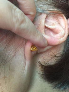 耳钉的塑料耳塞变硬了,无法将耳钉取下来,有什么办法能让发硬的耳塞取下来 