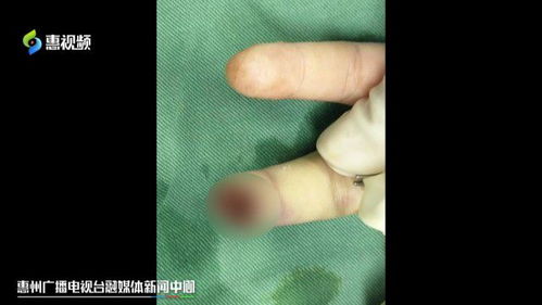 7岁女孩手指被夹断 医院紧急修复