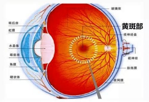 守护光明 市一院眼科修复一例巨大黄斑裂孔