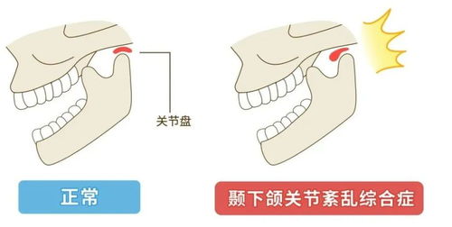 关节咔咔响 肚子咕咕叫 身体发出这4种声音或是疾病预警