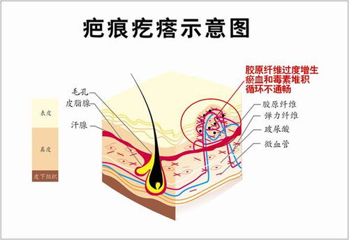 胥肖琴医生 胸前为什么是疤痕疙瘩的重灾区