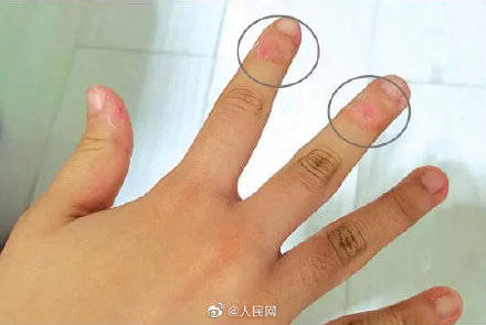 警惕 12岁女孩爱啃手指啃至变形