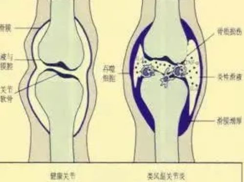 类风湿性关节炎引起关节疼怎么办 这些事项一定要牢记