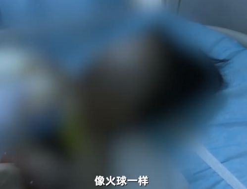 深圳一居民在家中被雷电击中烧伤,伤者女儿 雷雨天一道白光闪入家中 