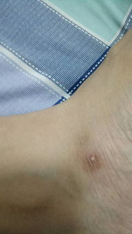我的左脚去年摔伤的旧伤疤上长了白色的凸起来的东西,这是什么,严重 