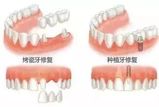 长期缺牙还会影响寿命长短 有根据吗