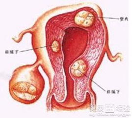 我妈妈前年被查出子宫内膜息肉鞋子要怎么治疗