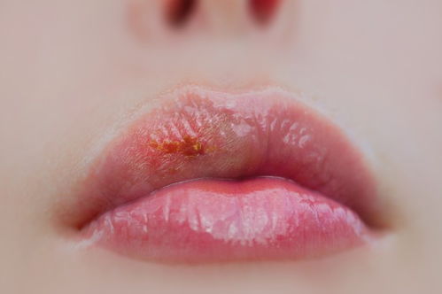 美人有约嘴角长疱疹如何快速治愈 有哪些治疗的办法
