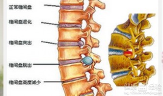 什么叫腰椎间盘突出