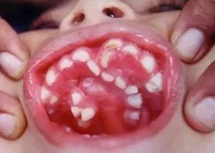 罕见长牙齿 都是因为宝妈在孕期多吃了这些食物