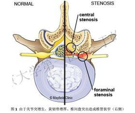 微创腰椎减压 椎体间融合术简介 原创