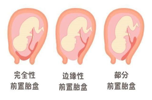 胎盘位置就能看出胎儿性别 不如抛开迷信,看看科学能判断什么