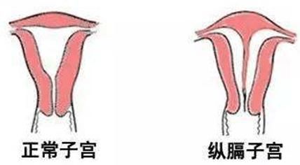 子宫的 照妖镜 解密宫腔镜