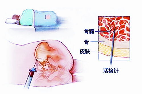 3岁男童患白血病,父亲忍痛做骨髓穿刺,这个疼痛需要忍吗