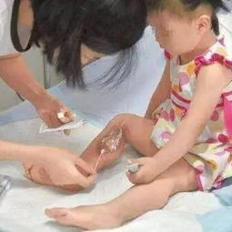 2岁娃被烫伤,家长涂牙膏孩子差点丢命 5种错误急救别用了 