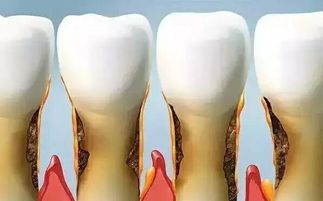 牙周炎导致牙齿松动了怎么办