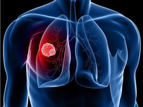 仅18 的肺癌患者可完全治愈,身体出现这几个隐蔽迹象要警惕 