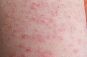 青岛专家讲解如何应付急性过敏性荨麻疹