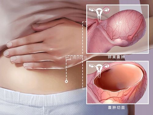 卵巢为什么会长囊肿 囊肿会癌变吗 6个问题一次说清