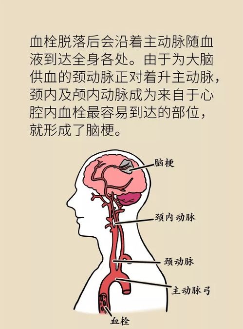 中国房颤日 脑梗风险增高十倍 超过千万人得病还不自知