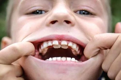 为什么很多人牙齿参差不齐 很可能和吃食物太软有关,从小做起
