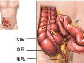 阑尾炎穿孔