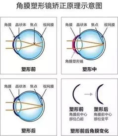 角膜塑形镜视力达不到1.0的原因(角膜塑形镜达不到1.0能否控制近视增长)