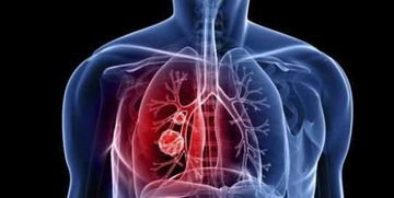 正常人有必要做肺部ct吗 肺部阴影可能是哪些疾病 看完后明白