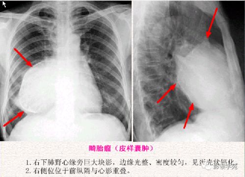 6种纵隔囊性病变的诊断与鉴别