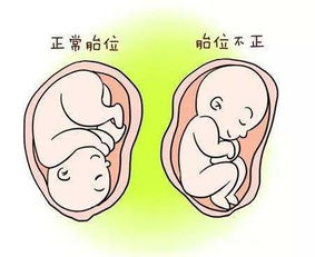 胎位臀位，胎位臀位是什么意思